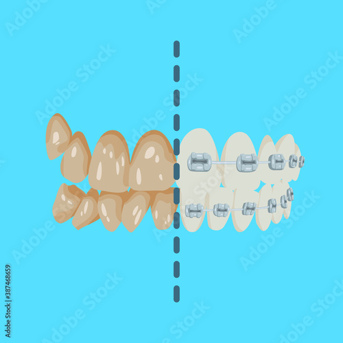 Two versions of the jaw with teeth.  Dirty and aching teeth versus teeth with braces