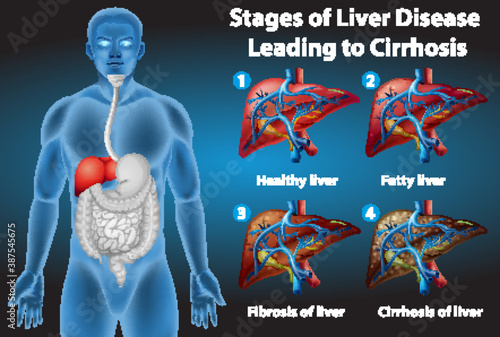 Stages of liver disease