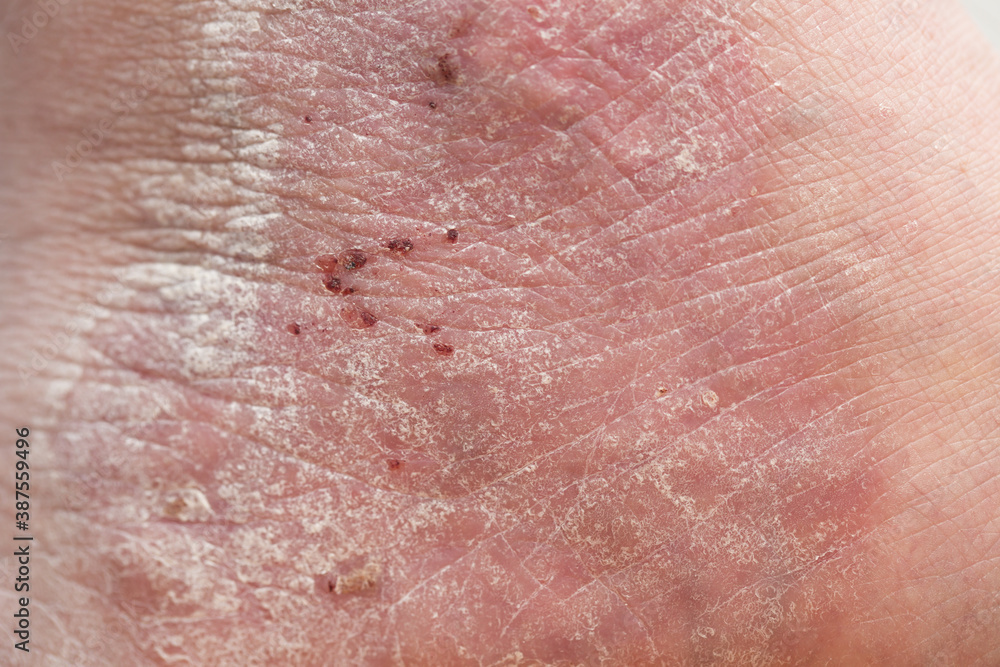 Fototapeta premium Psoriasis: close-up of the back of a patient affected by psoriasis