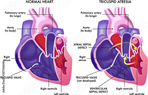Medical illustration that compare a normal heart with a heart affected by cardiac defect called Tricuspid Atresia, with annotations.