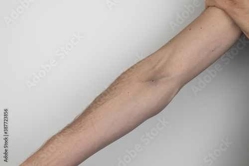 A male drug addict shows his hands and veins, which show bruises from the injections. The concept of dependence and injecting drugs into one’s veins.