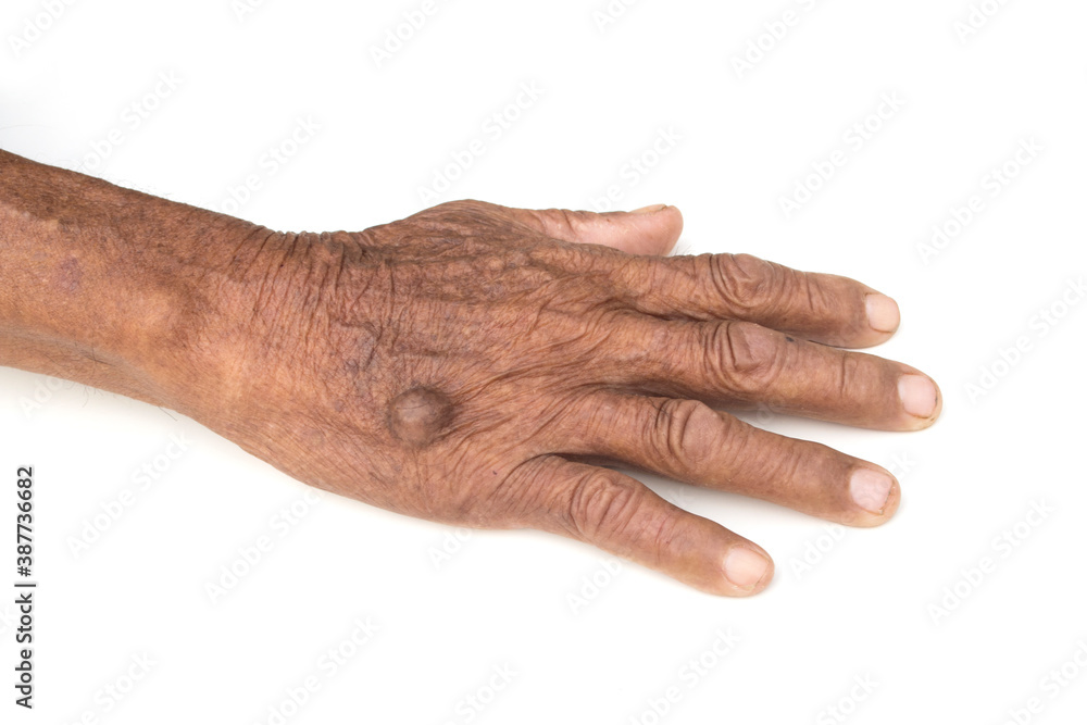 Big ganglion cyst back on hand of man on white background. Big ganglion cyst back on hand of man on white background.
