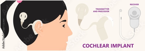 Cochlear implant device electrically stimulates nerve medical aid ear sound wave adults hard middle exam