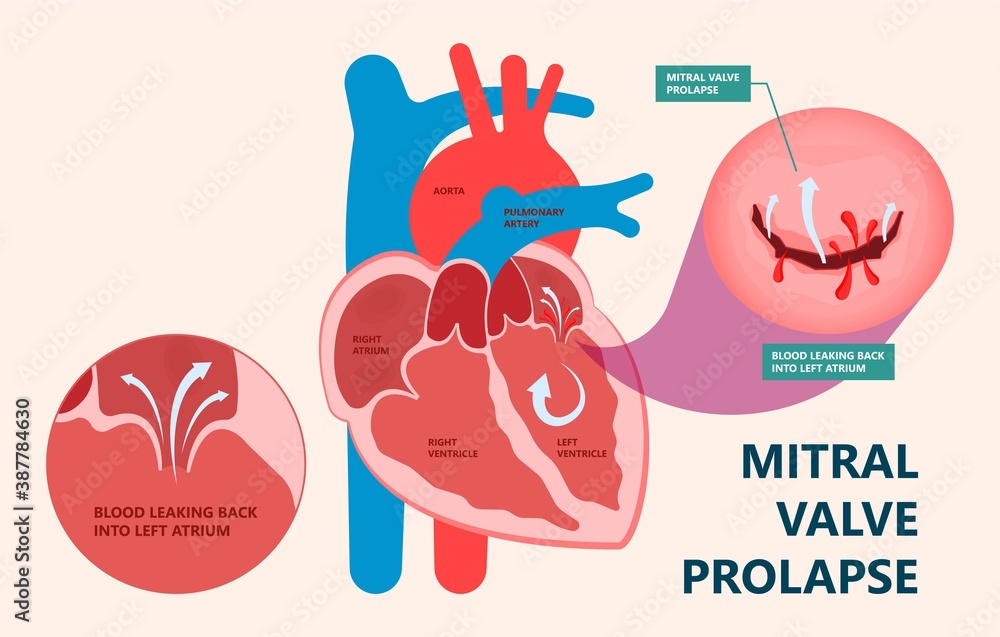 Cath Lab Atrial Septal Defect Tetralogy of Fallot Patent Foramen Ovale