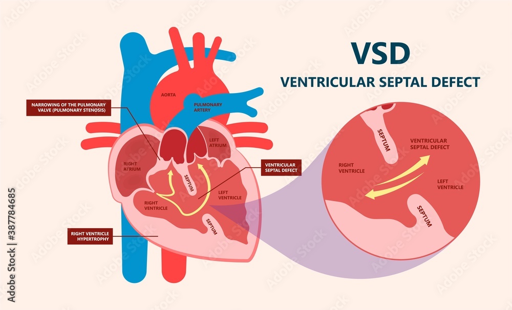 Cath Lab Atrial Septal Defect Tetralogy of Fallot Patent Foramen Ovale ...