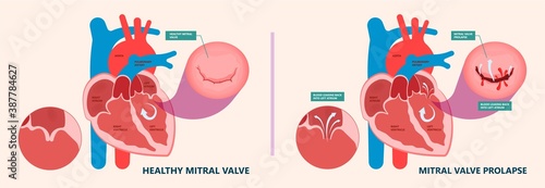 Cath Lab Atrial Septal Defect Tetralogy of Fallot Patent Foramen Ovale Mitral Valve Stenosis Heart Attack Ductus Arteriosus Doppler Coronary Artery Disease Congestive Congenital Valvular VSD exam leak