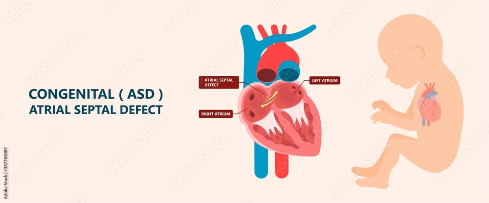 Cath Lab Atrial Septal Defect Tetralogy of Fallot Patent Foramen Ovale Mitral Valve Stenosis Heart Attack Ductus Arteriosus Doppler Coronary Artery Disease Congestive Congenital Valvular VSD exam leak Cath Lab Atrial Septal Defect Tetralogy of Fallot Patent Foramen Ovale Mitral Valve Stenosis Heart Attack Ductus Arteriosus Doppler Coronary Artery Disease Congestive Congenital Valvular VSD exam leak