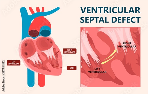 Cath Lab Atrial Septal Defect Tetralogy of Fallot Patent Foramen Ovale Mitral Valve Stenosis Heart Attack Ductus Arteriosus Doppler Coronary Artery Disease Congestive Congenital Valvular VSD exam leak