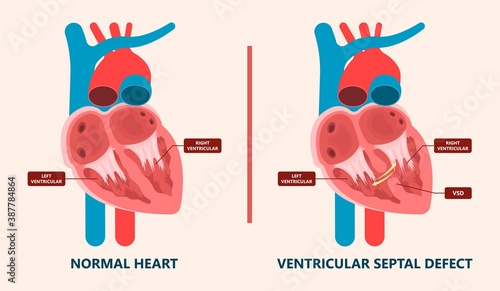 Cath Lab Atrial Septal Defect Tetralogy of Fallot Patent Foramen Ovale Mitral Valve Stenosis Heart Attack Ductus Arteriosus Doppler Coronary Artery Disease Congestive Congenital Valvular VSD exam leak