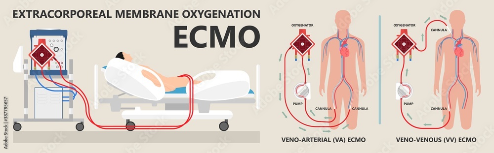 Extracorporeal membrane oxygenation ECMO a life support system for Respiratory failure patient system illness damage Infection perfusionist Ards transplant myocarditis embolism Extracorporeal membrane oxygenation ECMO a life support system for Respiratory failure patient system illness damage Infection perfusionist Ards transplant myocarditis embolism