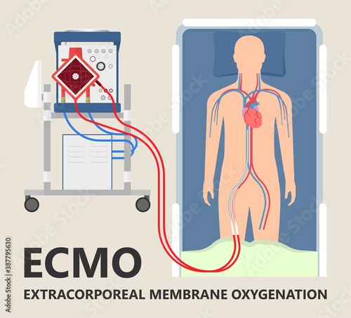 Extracorporeal membrane oxygenation ECMO a life support system for Respiratory failure patient system illness damage Infection perfusionist Ards transplant myocarditis embolism