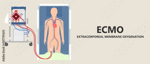 Extracorporeal membrane oxygenation ECMO a life support system for Respiratory failure patient system illness damage Infection perfusionist Ards transplant myocarditis embolism