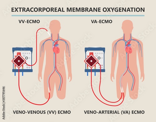 Extracorporeal membrane oxygenation ECMO a life support system for Respiratory failure patient system illness damage Infection perfusionist Ards transplant myocarditis embolism