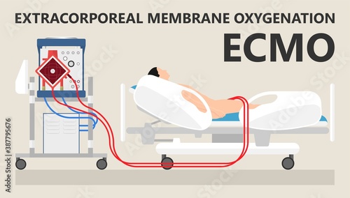 Extracorporeal membrane oxygenation ECMO a life support system for Respiratory failure patient system illness damage Infection perfusionist Ards transplant myocarditis embolism