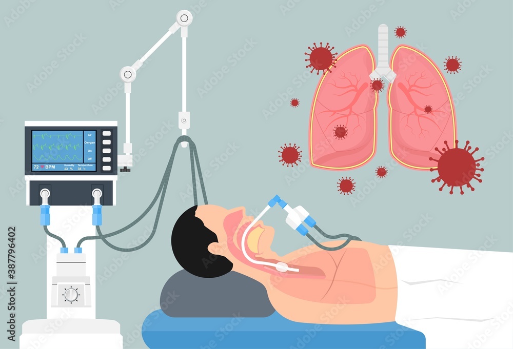 Acute respiratory distress syndrome (ARDS) a respiratory failure and inflammation in the lungs