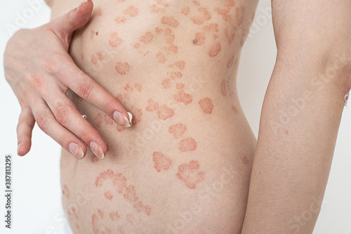 A girl with psoriasis. She can use ointments and creams to cure it and get rid of itching.