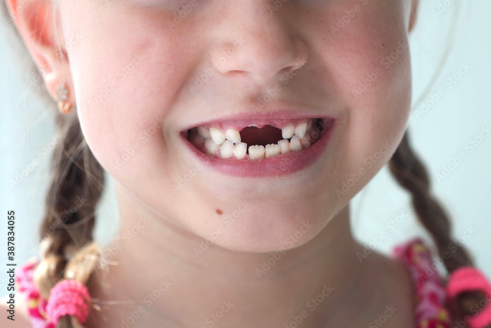 Close-up smile of a girl. A beautiful little girl 6-7 years old has lost milk teeth. Loss of milk teeth, replacement of permanent teeth. Close-up smile of a girl. A beautiful little girl 6-7 years old has lost milk teeth. Loss of milk teeth, replacement of permanent teeth.
