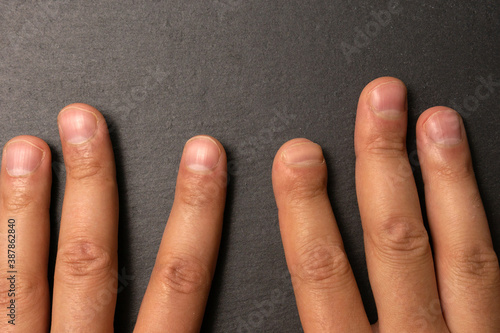 index finger after hand surgery. Damaged finger. after gangrene photo