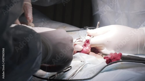 Close up of genitals of a patient who has testicular cancer. Action. Surgeons cutting out a tumor from male tescticle in the operating room in a hospital.