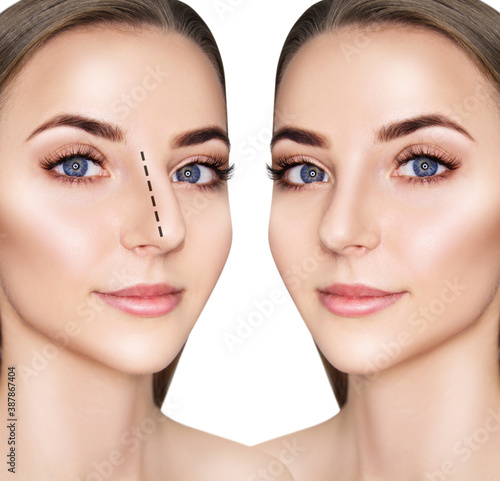 Female nose before and after plastic surgery.