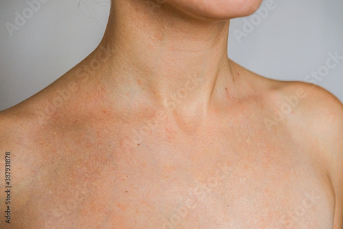 Psoriasis skin disease is a dermatic problem, red allergic skin rash.