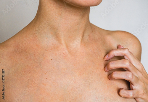 Valokuva Psoriasis skin disease is a dermatic problem, red allergic skin rash