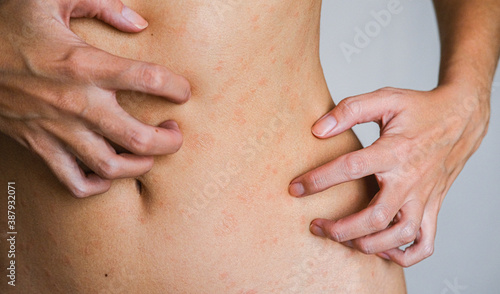 Psoriasis skin disease is a dermatic problem, red allergic skin rash. photo
