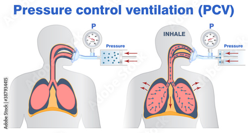Illustration of pressure control or support artifitial ventilation. Tidal volume, mask ventilation, breathing resuscitator bag ventilation. photo