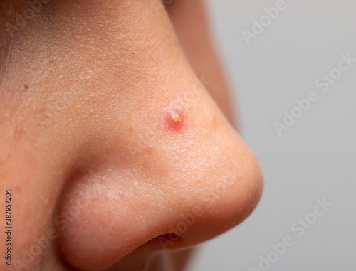 inflamed acne on the nose