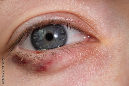 Fototapeta Naklejka Na Ścianę i Meble -  Close-up of a child's eye stye. Ophthalmic hordeolum disease
