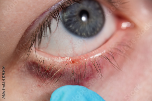 close up of the eyelid nevi during eye examination. photo