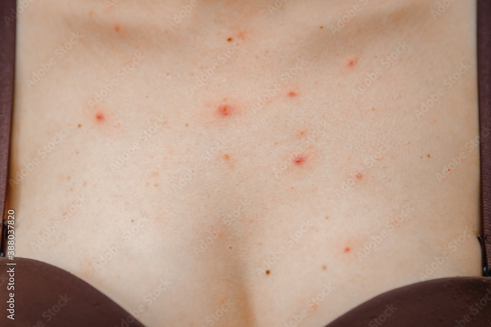 Φωτογραφία Close-up skin of adult woman affected by chickenpox, acne and dermatology