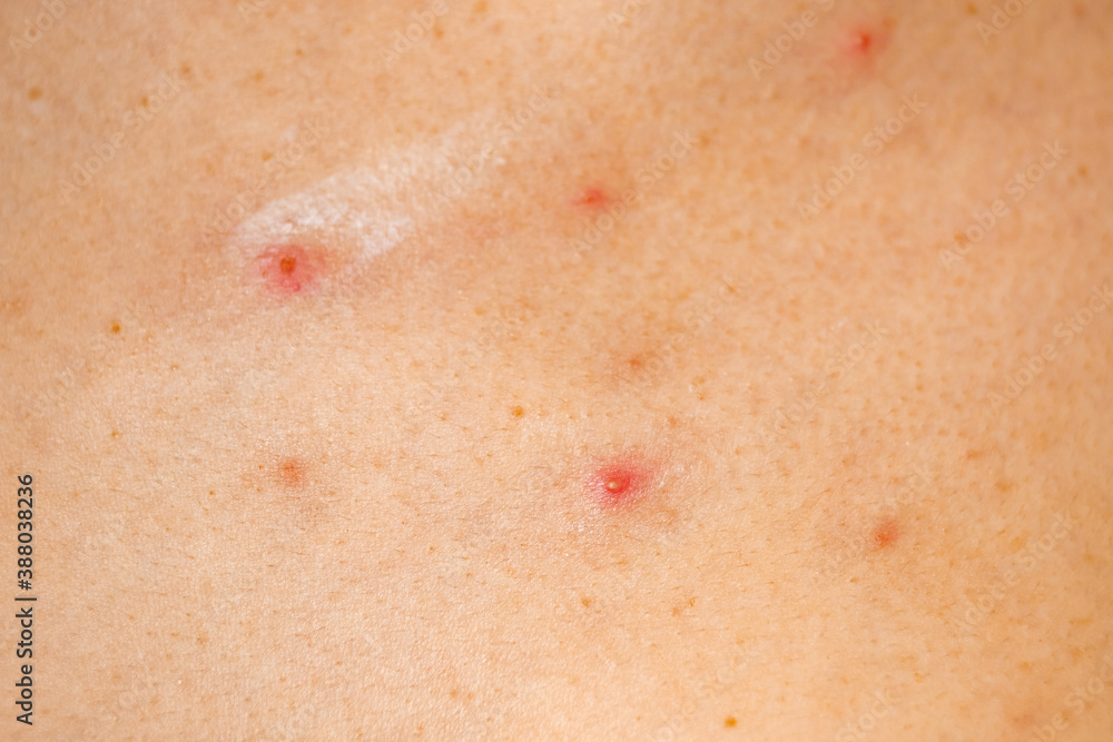 Φωτογραφία Close up back of adult girl skin is affected by chickenpox