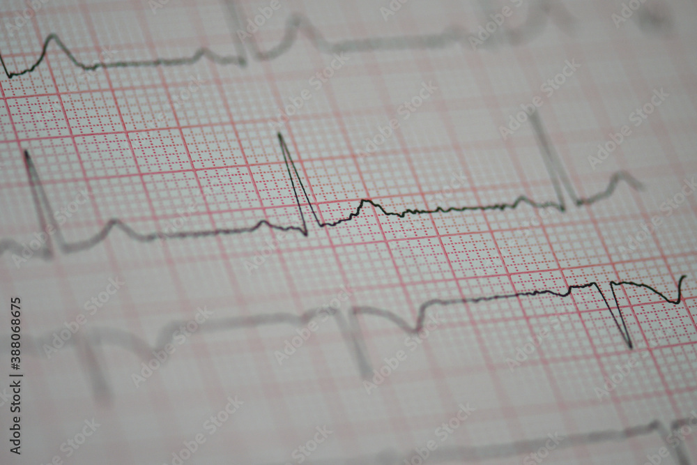 Heart beat on ECG Heart beat on ECG