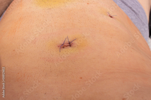 sutures on the wound after laparoscopic surgery