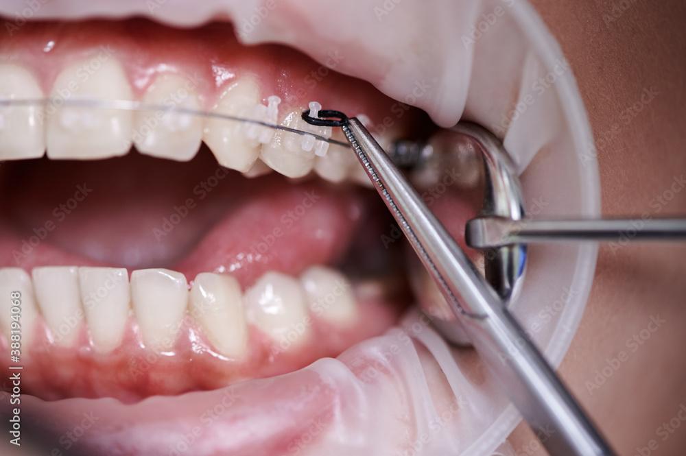 Close up view on dentist taking off black rubber bands from ceramic braces  with a help