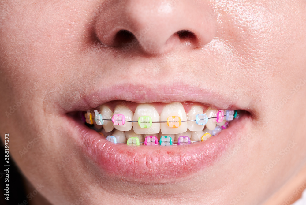 Naklejka premium Horizontal close-up snapshot of beautiful woman's smile, demonstrating white healthy teeth with ceramic braces, united with a wire and colorful rubber bands. Front view with a tip of nose