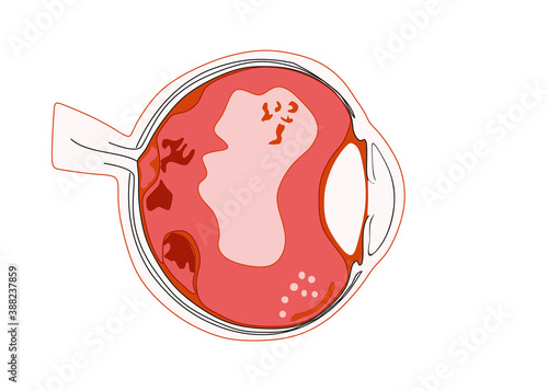 Destruction of the vitreous body Types of Floaters white blood cell deposits Fluid pockets vitreous strands Fragment of retina Neovascularization Retinal tissue.