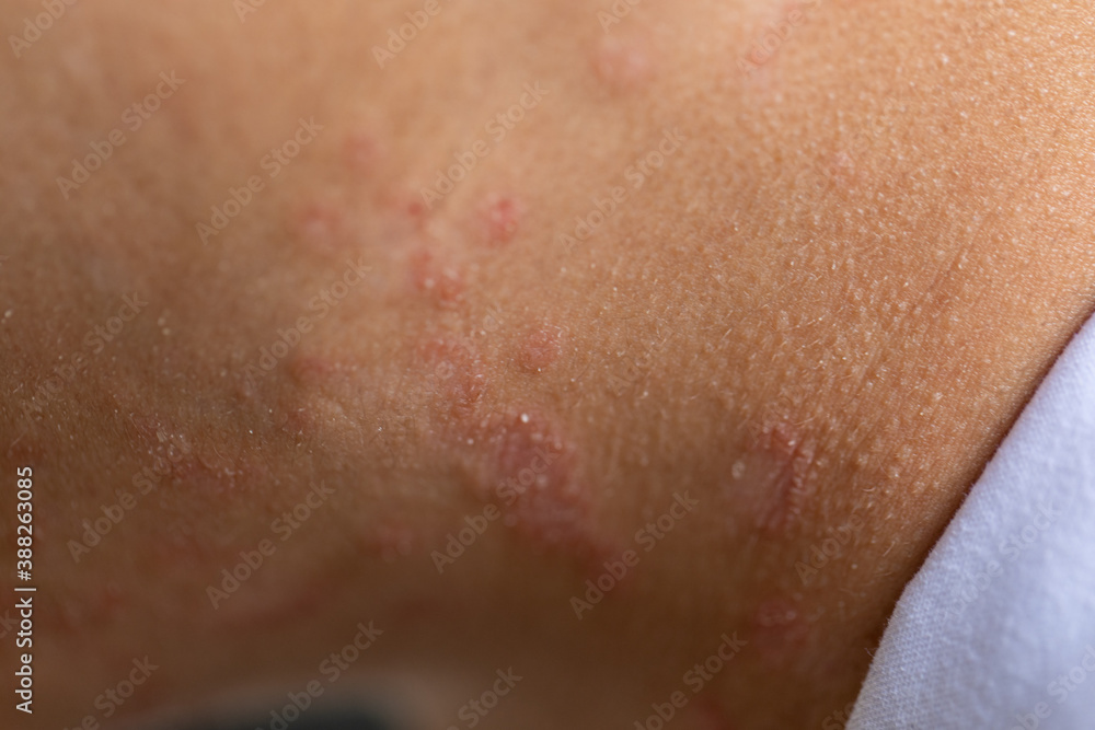 Fototapeta premium Tinea circinata or ringworm on the head.