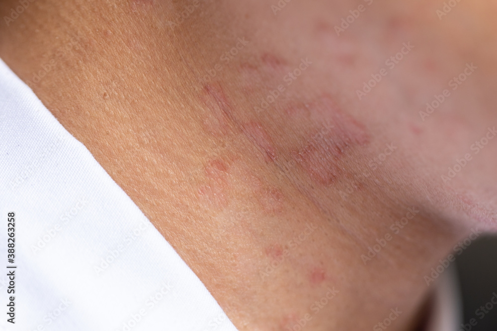Tinea circinata or ringworm on the head.
Tinea circinata or ringworm on the head.