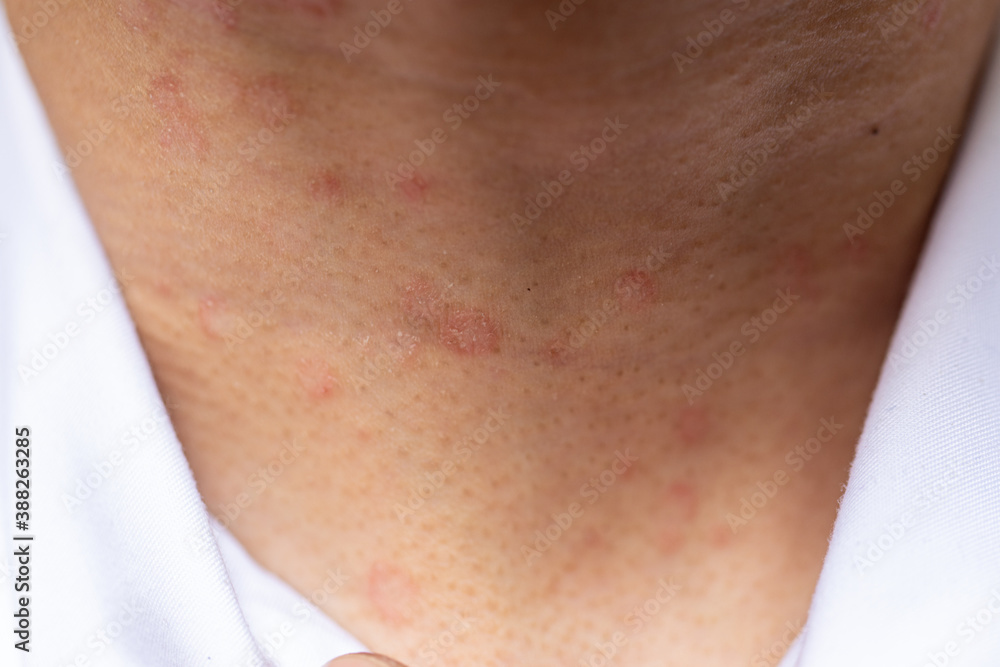 Tinea circinata or ringworm on the head.
Tinea circinata or ringworm on the head.