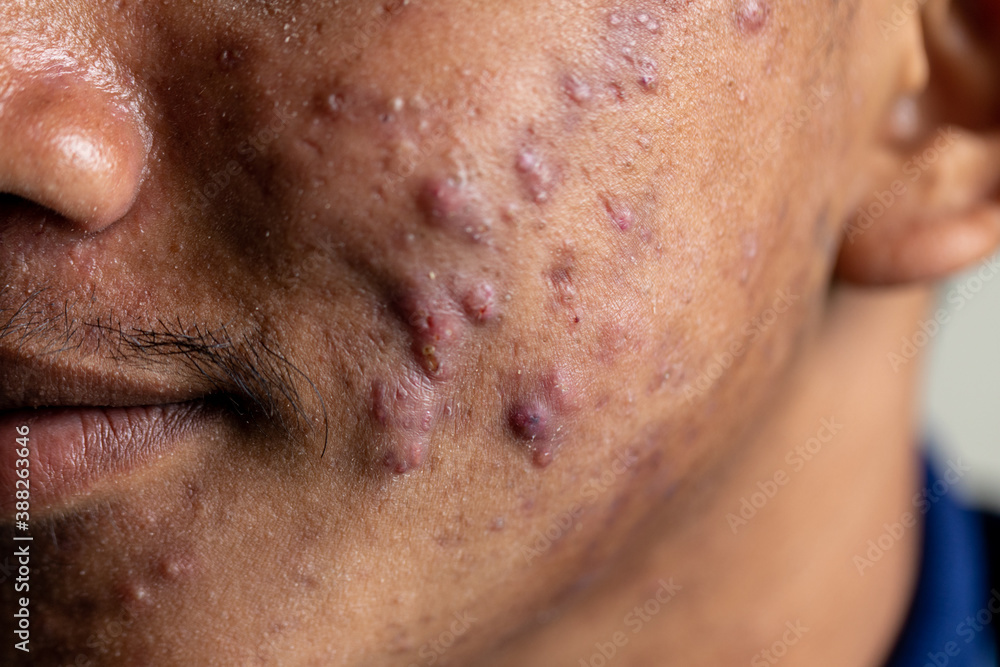 Backgrounds of lesions skin caused by acne on the face in the clinic.
Backgrounds of lesions skin caused by acne on the face in the clinic.
