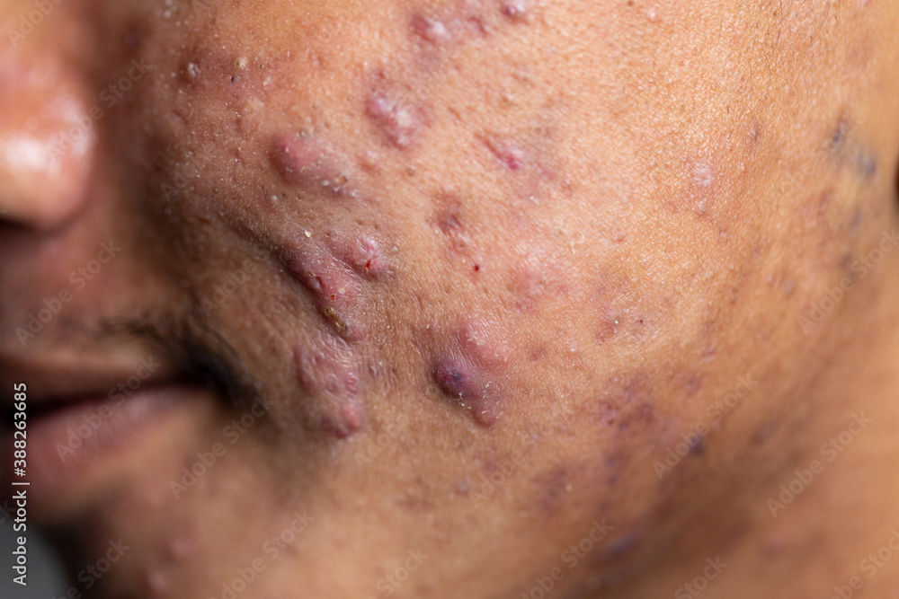 Backgrounds of lesions skin caused by acne on the face in the clinic.
Backgrounds of lesions skin caused by acne on the face in the clinic.