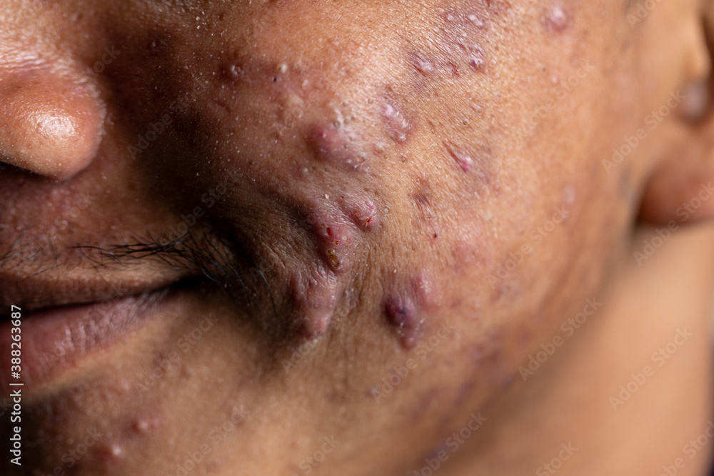 Backgrounds of lesions skin caused by acne on the face in the clinic.
Backgrounds of lesions skin caused by acne on the face in the clinic.