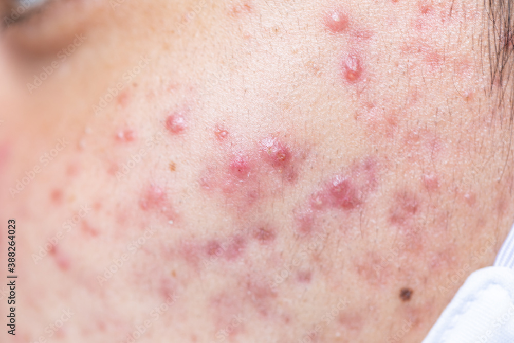 Backgrounds of lesions skin caused by acne on the face in the clinic.
Backgrounds of lesions skin caused by acne on the face in the clinic.