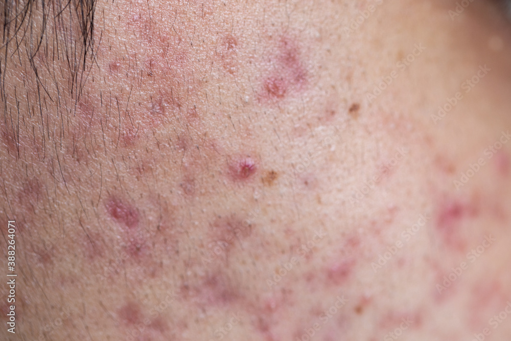 Fototapeta premium Backgrounds of lesions skin caused by acne on the face in the clinic. 
