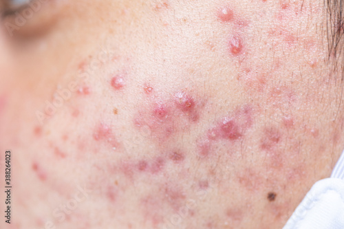 Backgrounds of lesions skin caused by acne on the face in the clinic.
