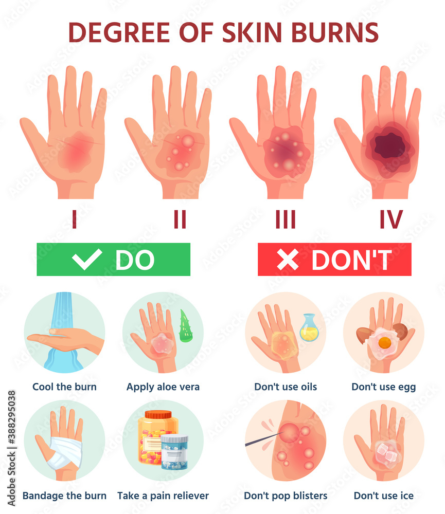 Burns degree. First aid for burn wound. Fire damage to skin classification.  Hand blisters. Vector infographic treatment for thermal wound. Illustration  injury pain damage, medicine help Stock Vector | Adobe Stock