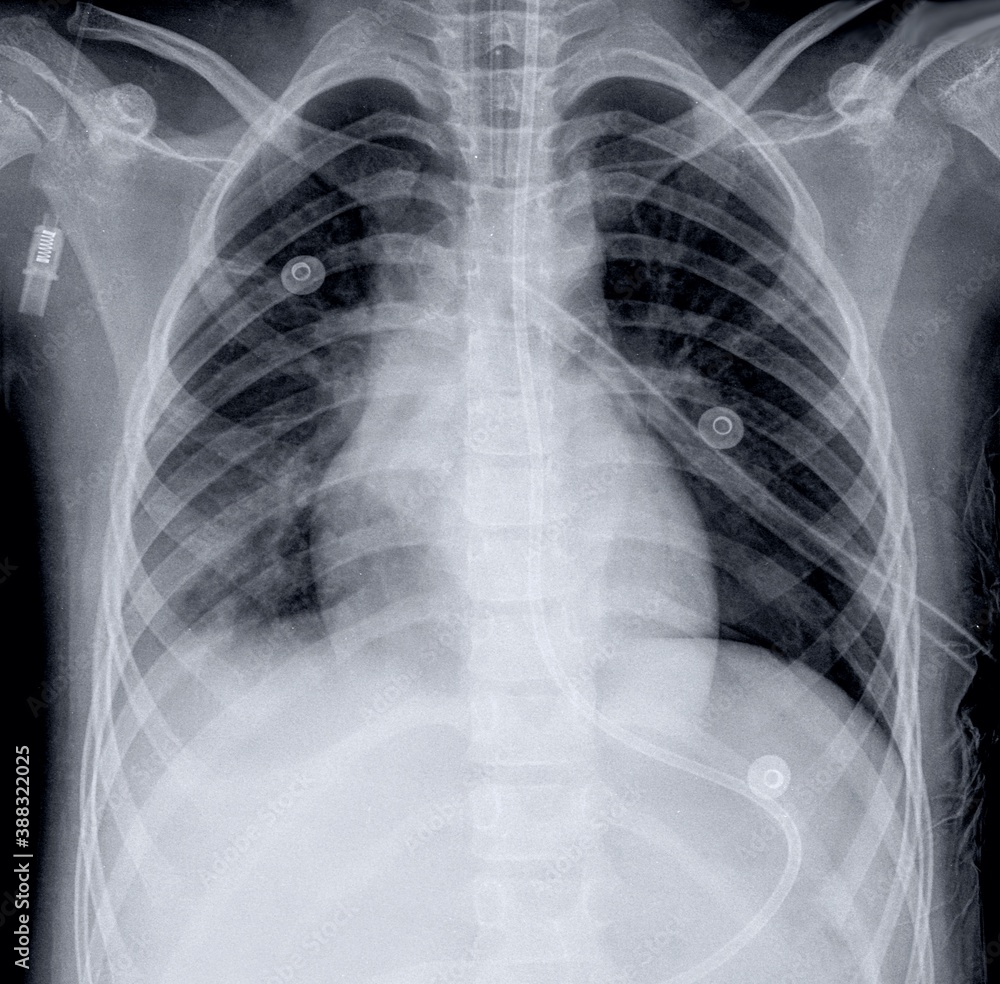 Atelectasis Vs Pneumonia Chest X Ray