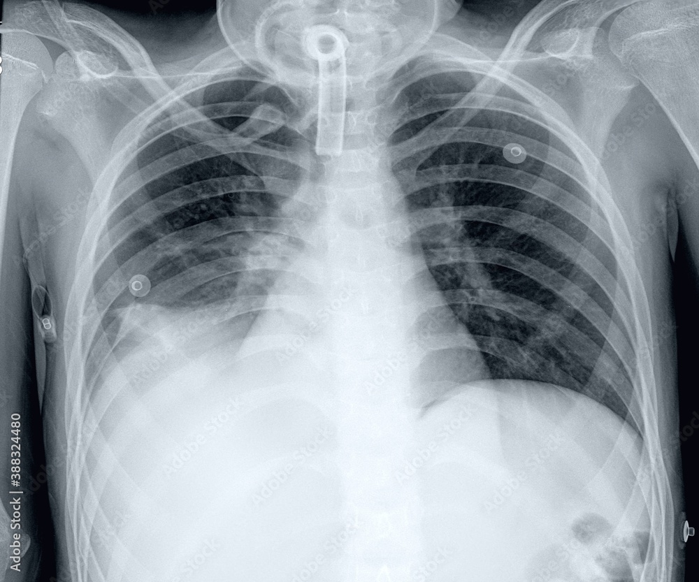 Atelectasis Vs Pneumonia Chest X Ray